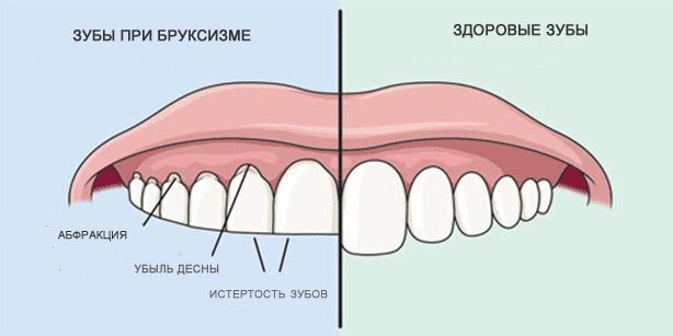 Grincement des dents: dents saines et des dents pendant bruxisme