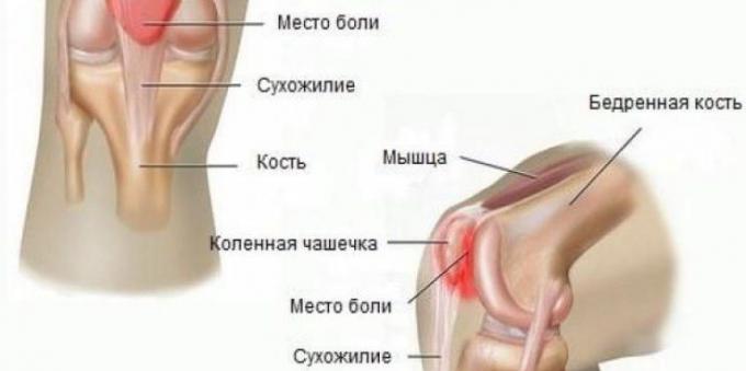 Pourquoi blesser vos genoux: le syndrome fémoro-patellaire