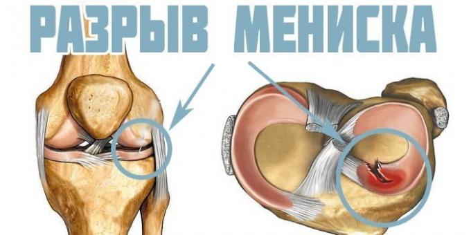 Pourquoi blesser vos genoux: blessure Ménisque