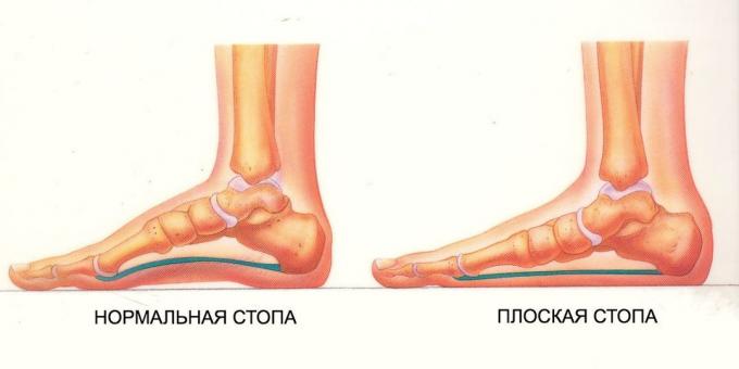 exercices pour les pieds plats: pied normal et plat