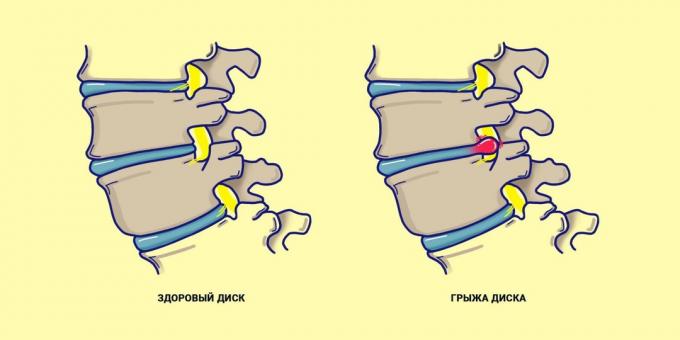 la colonne vertébrale hernies par rapport à un dos en bonne santé