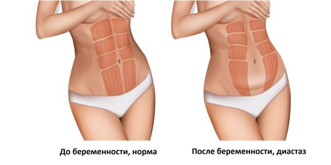 Diastase des muscles droits de l'abdomen