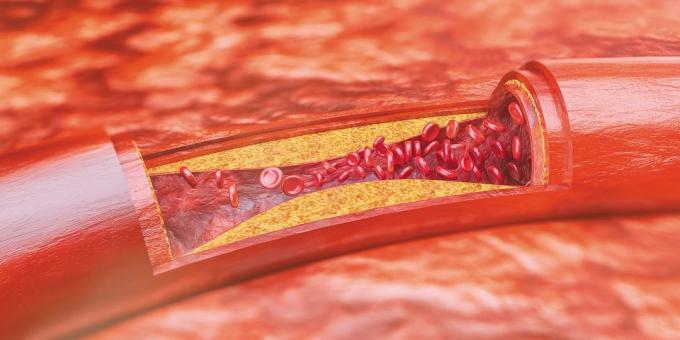 Cholestérol: plaques athéroscléreuses
