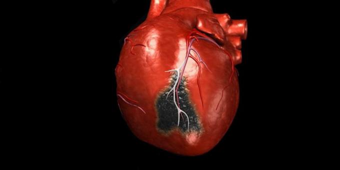 Les symptômes d'une crise cardiaque, pour lequel vous avez besoin d'appeler une ambulance
