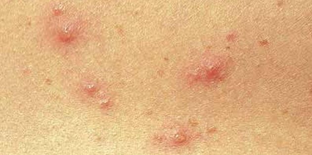 Les symptômes de la varicelle chez les enfants et les adultes: Très souvent, la peau apparaissent immédiatement de petits points rouges