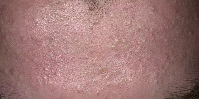 Comment se débarrasser de l'acné: comédons fermés